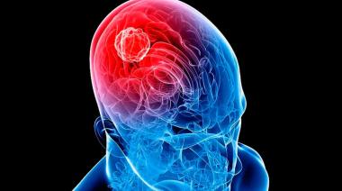Tumores cerebrales: una patología que puede provocar graves secuelas si no es controlada a tiempo