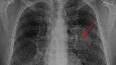 Cáncer de pulmón: el tumor que más muertes provoca en la Argentina y un preocupante crecimiento de casos en mujeres