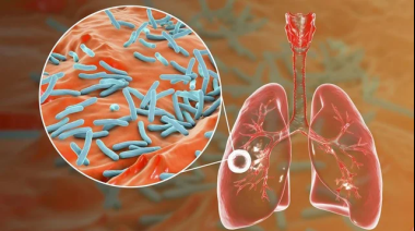 Tuberculosis: se notificaron más de 13.000 casos en Argentina