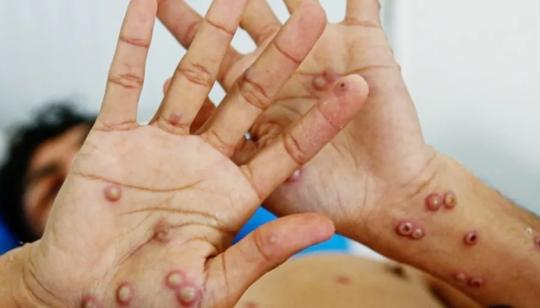 Confirman en Argentina un caso de viruela símica de la variante más contagiosas