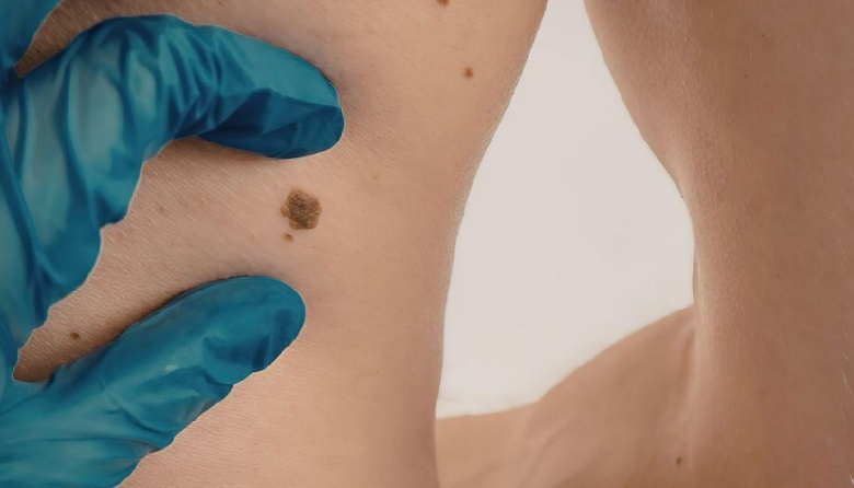 Día Mundial del Melanoma: lo que recomiendan los especialistas para detectarlo antes