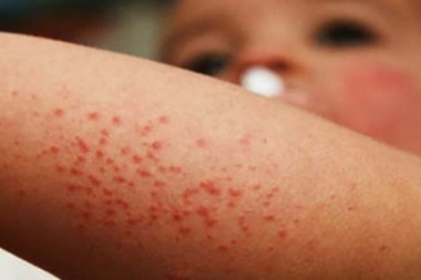 Preocupación: 61 casos de sarampión en el país