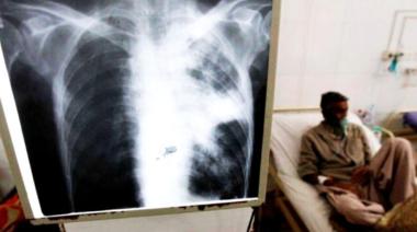 Tuberculosis: entre 2020 y lo que va de 2025 los casos aumentaron un 65%