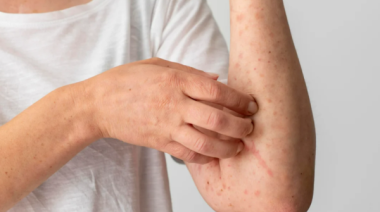 Confirmaron un caso de sarampión en un paciente de 29 años con antecedente de viaje