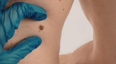 Día Mundial del Melanoma: lo que recomiendan los especialistas para detectarlo antes