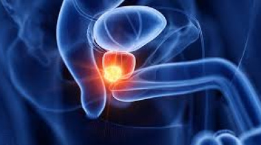 Día Mundial del Cáncer de Próstata: La importancia de la detección temprana