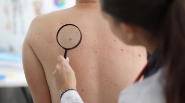Vacuna experimental contra el cáncer de piel tuvo resultados positivos