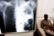 Tuberculosis: entre 2020 y lo que va de 2025 los casos aumentaron un 65%