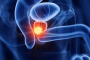 Día Mundial del Cáncer de Próstata: La importancia de la detección temprana