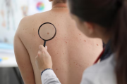 Vacuna experimental contra el cáncer de piel tuvo resultados positivos